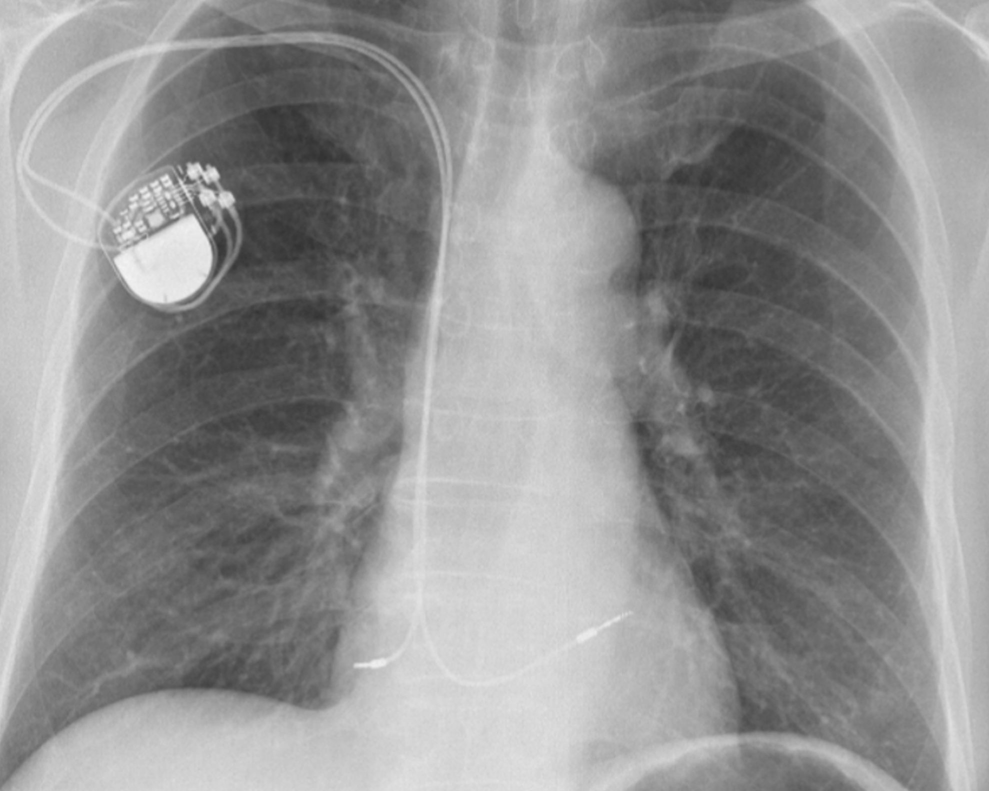 Die von uns etwicklete Applikation kann Herzschrittmacher und Defibrillatoren zuverlässig erkennen und prüfen, ob die implantierten Geräte MRI-kompatibel sind. Dies ist entscheidend, um die Sicherheit und Eignung für MRT-Untersuchungen zu gewährleisten